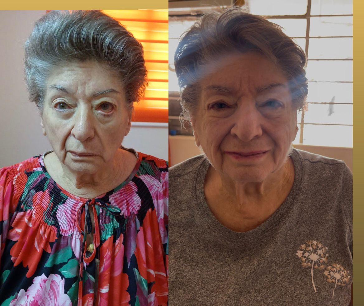 Sra. Aidé — Parálisis Facial de Bell